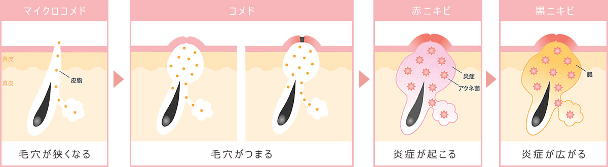 にきび（尋常性ざ瘡）