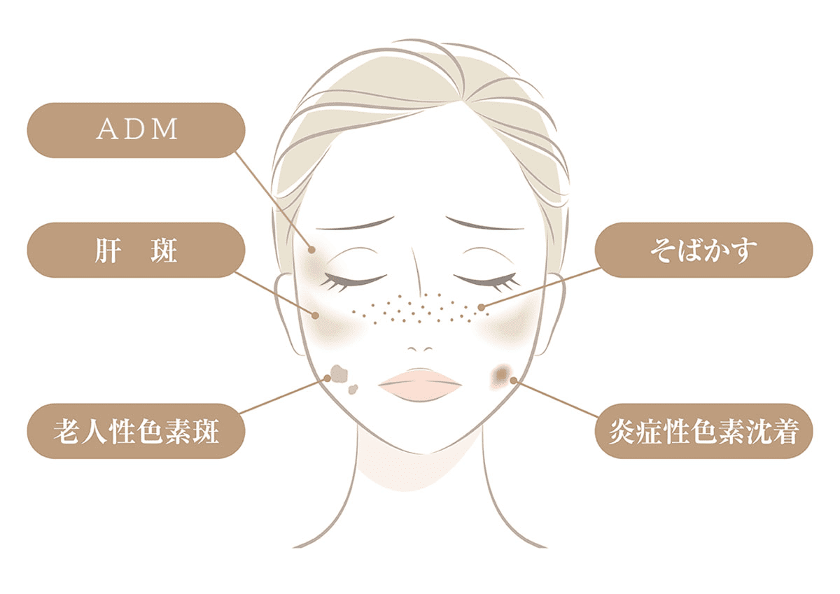 代表的なしみの種類
