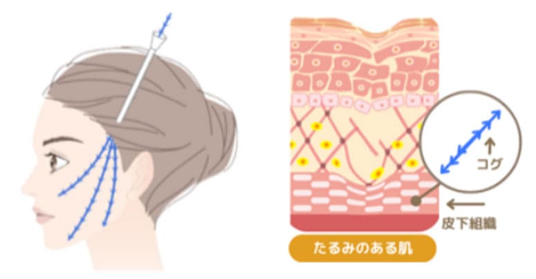 切らずに叶える、立体的リフトアップ治療