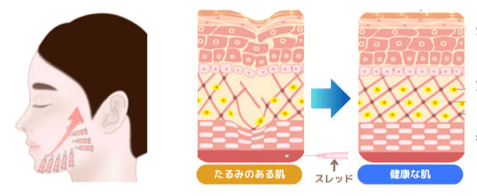 ショッピングリフト