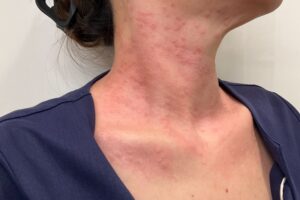 CO2 取り放題首 症例1 施術直後