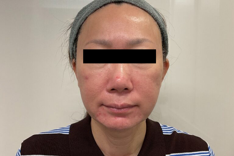 ベビーコラーゲン前①