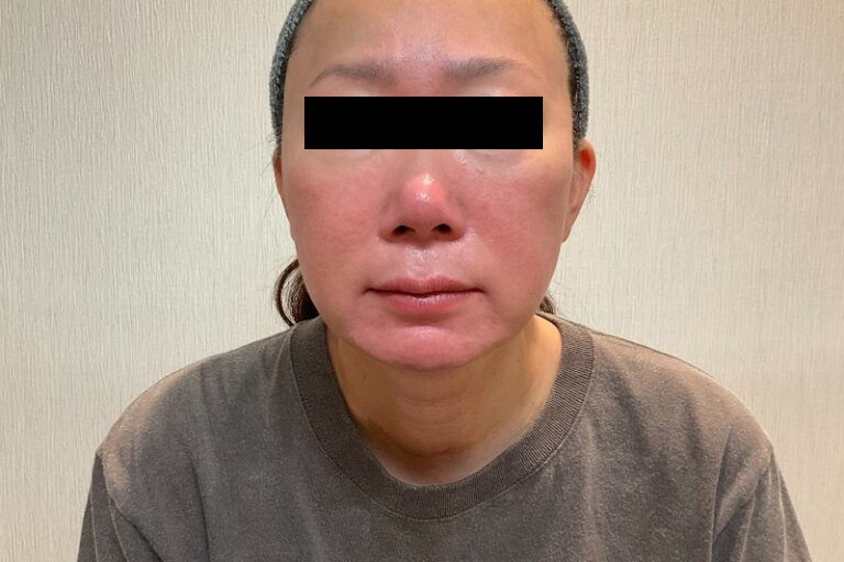 ベビーコラーゲン後②