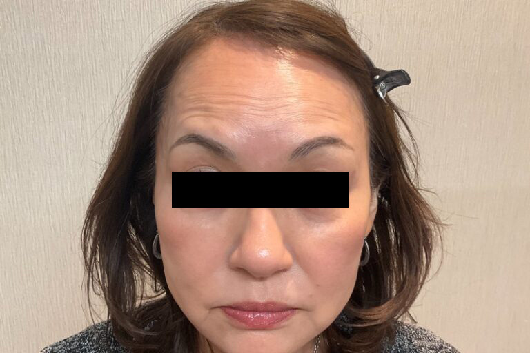 ボトックス額_Before