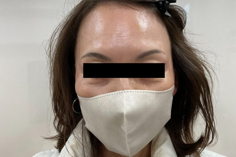 ボトックス額_After