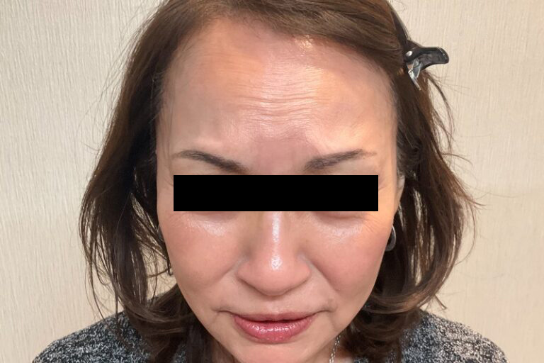 ボトックス眉間_Before