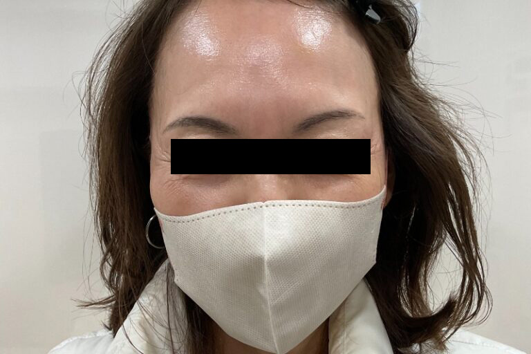 ボトックス眉間_After