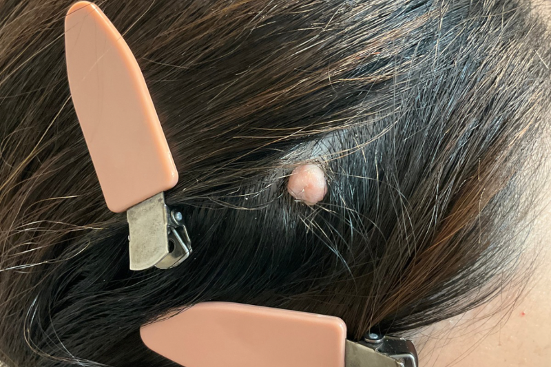 CO2 ホクロ 症例②施術前