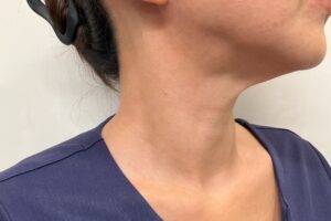 CO2 取り放題首 症例1 施術6ヶ月後