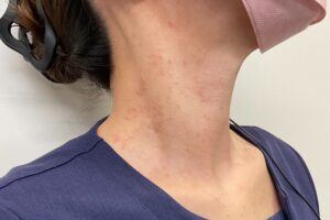 CO2 取り放題首　症例1 施術2週間後