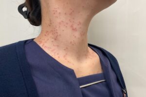 CO2 取り放題首　症例1 施術翌日