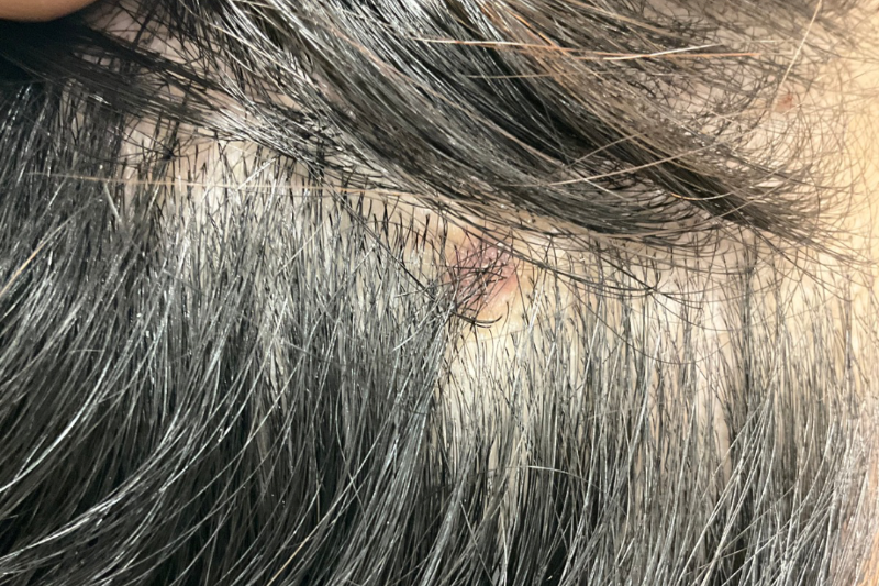 CO2 ホクロ 症例② 2週間後