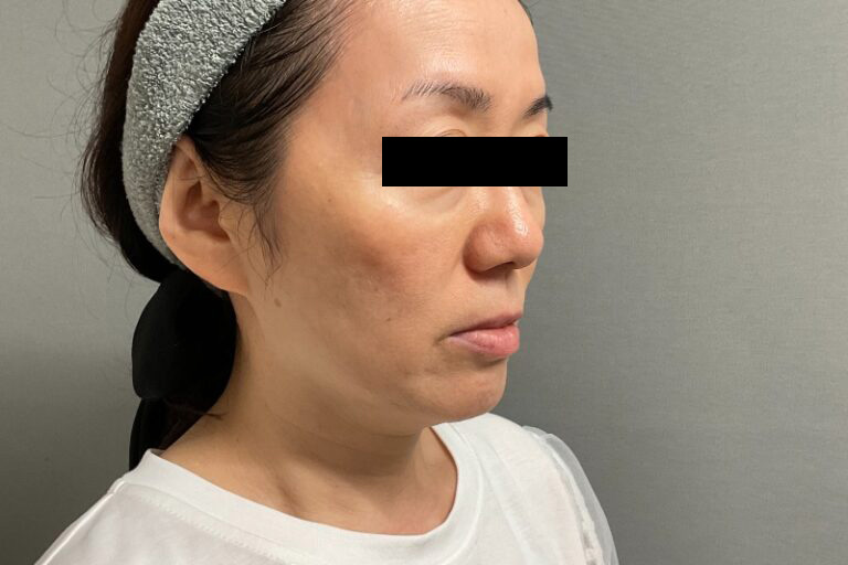 ヒアルロン酸①右_Before