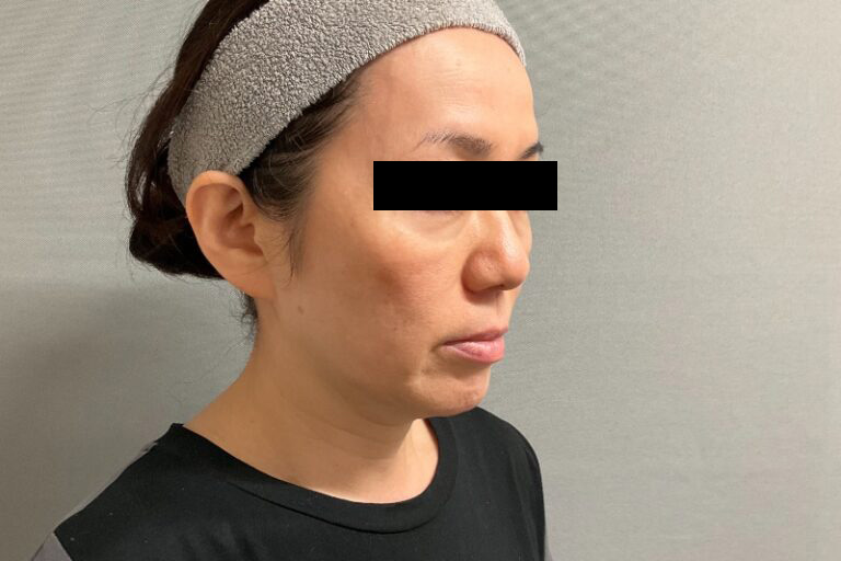 ヒアルロン酸①右_After