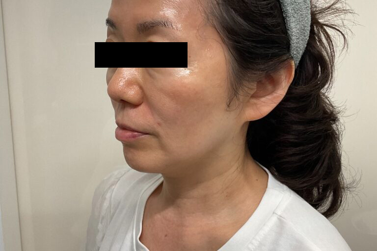 ヒアルロン酸①左_Before