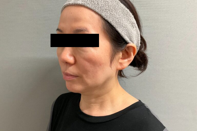 ヒアルロン酸①左_After