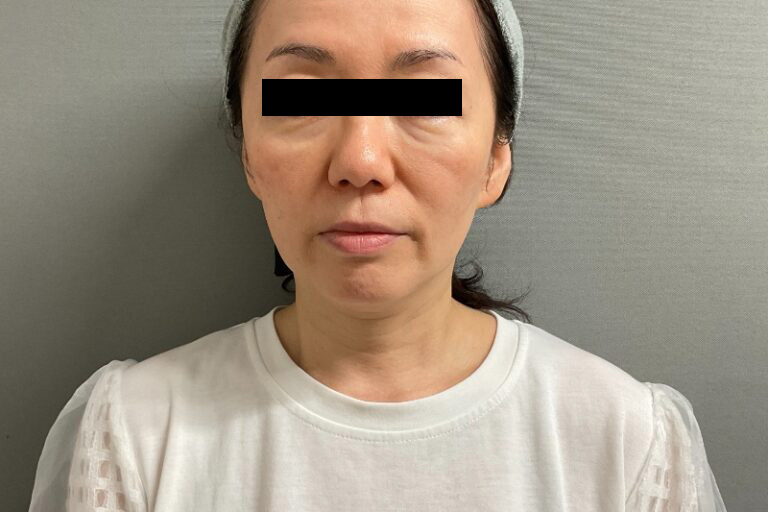 ヒアルロン酸①正面_Before