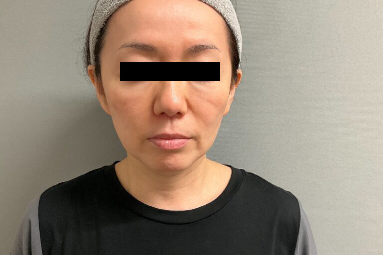 ヒアルロン酸①正面_After