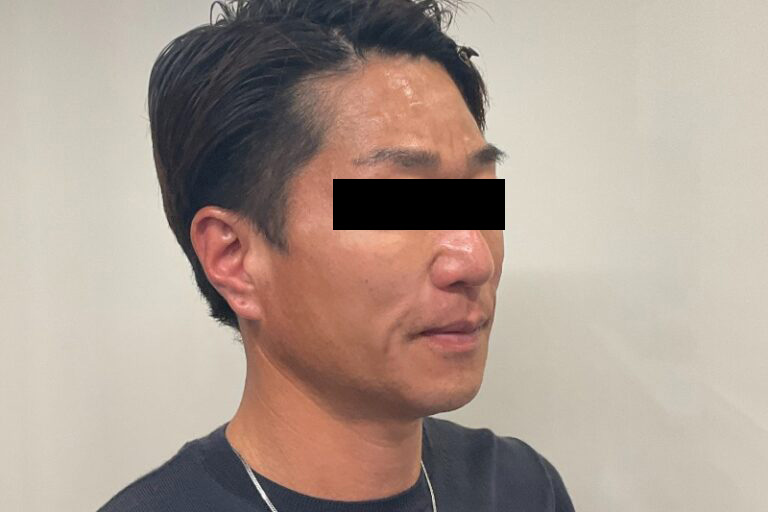 ヒアルロン酸②右_After