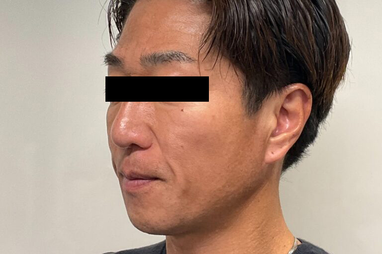 ヒアルロン酸②左_Before