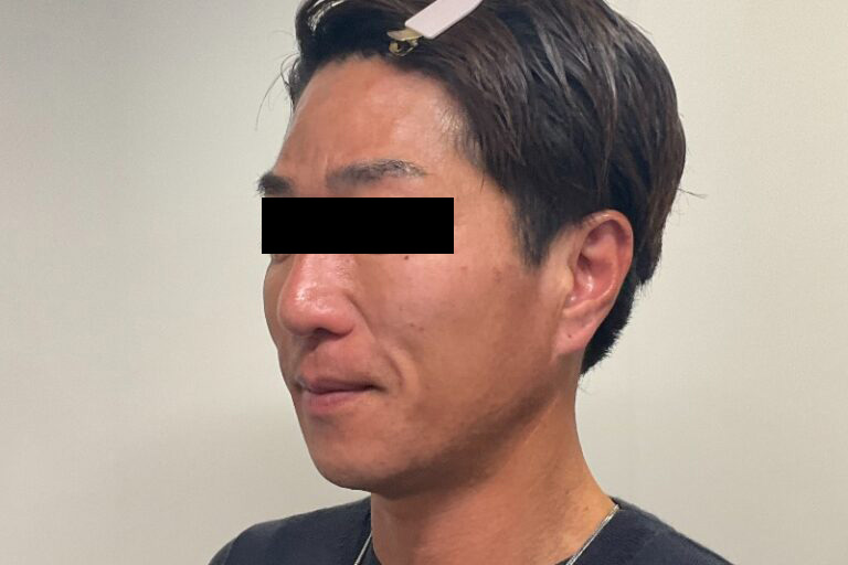 ヒアルロン酸②左_After