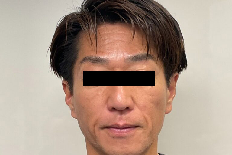 ヒアルロン酸②正面_Before