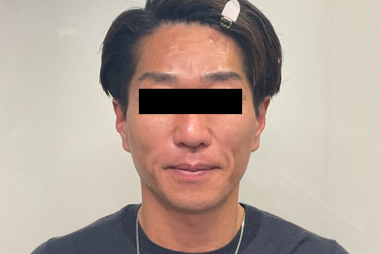 ヒアルロン酸②正面_After