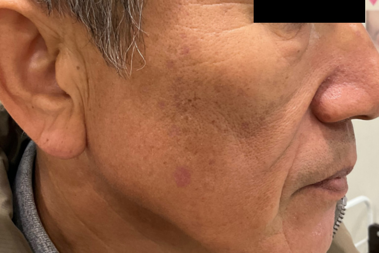 CO2 取り放題顔 症例② 施術2 週間後