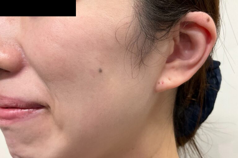 CO2 ホクロ 症例①施術前