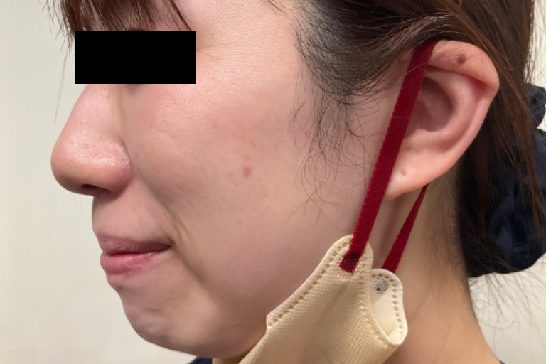 CO2ほくろ 半年後