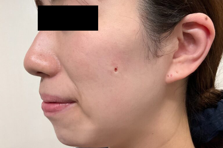 CO2 ほくろ 施術直後テープ貼付