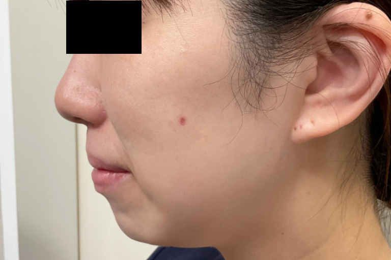 CO2ほくろ 2週間後