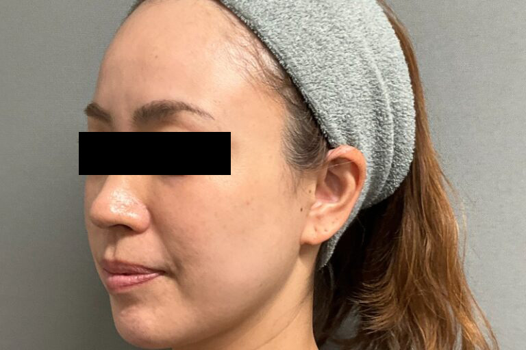 糸リフト前:横①