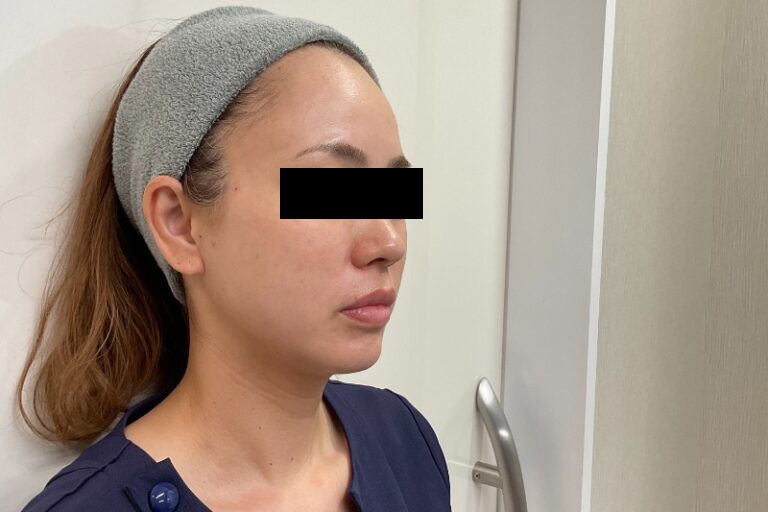 糸リフト後:横①