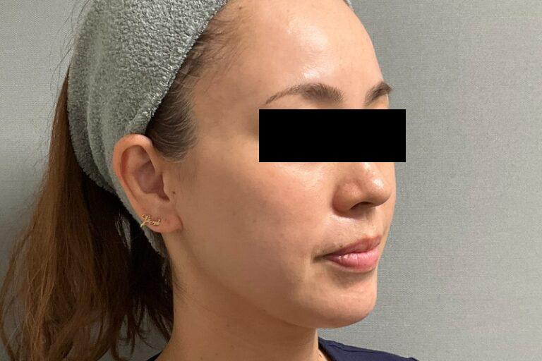 糸リフト前:横②