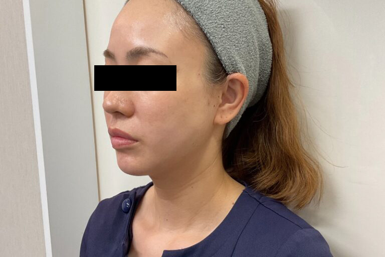 糸リフト後:横②