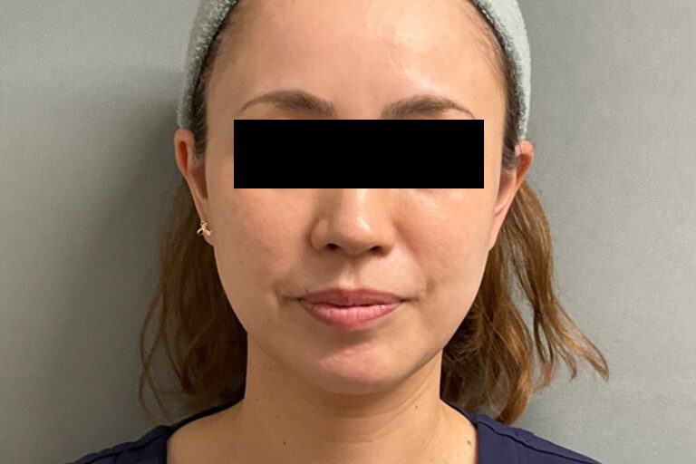 糸リフト前:正面