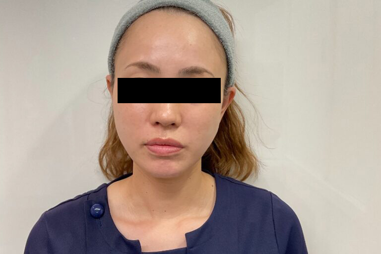 糸リフト後:正面