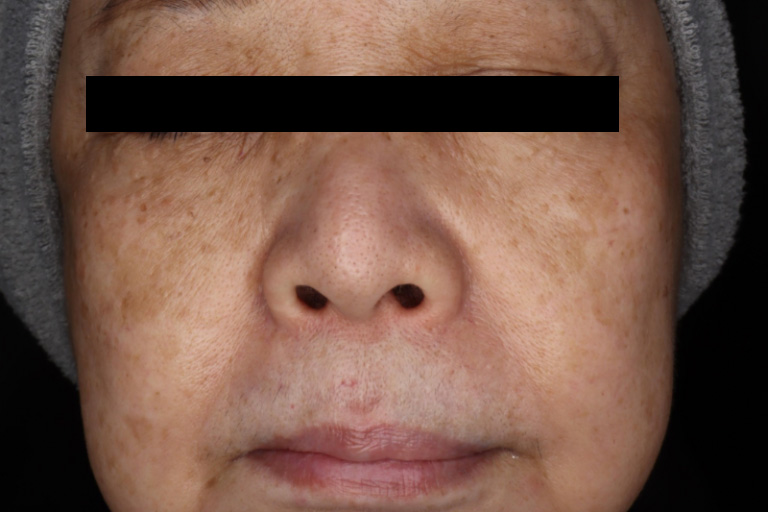 M22 しみ症例② 施術前