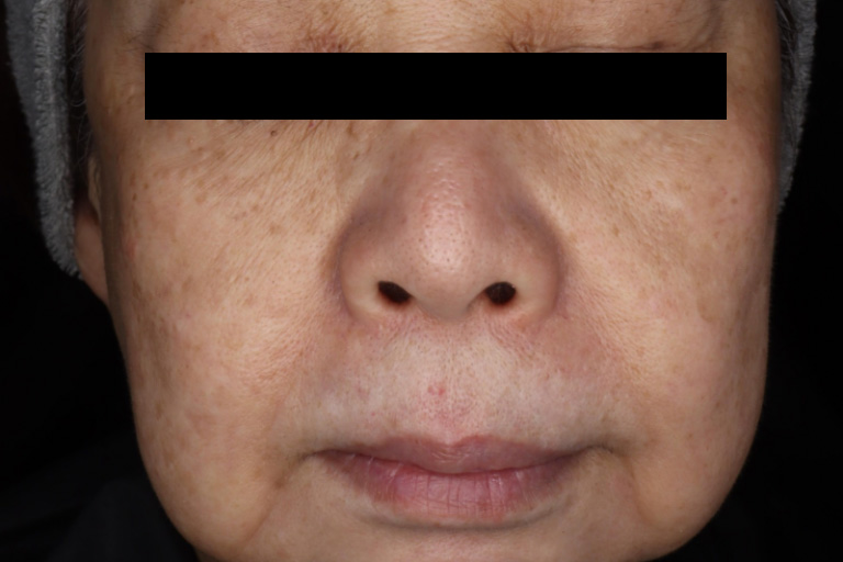 M22 シミ症例② 3回照射後