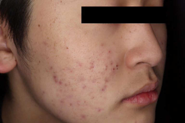 M22 にきび 施術前