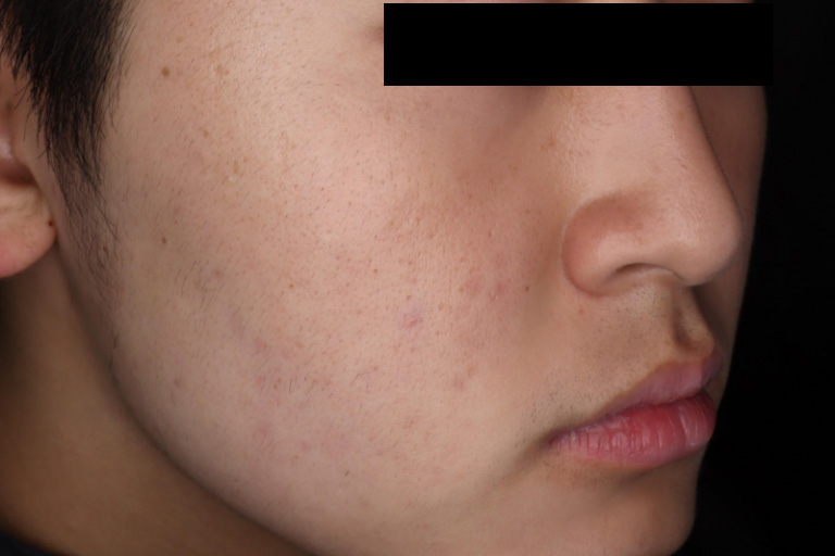 M22 ニキビ 5回後