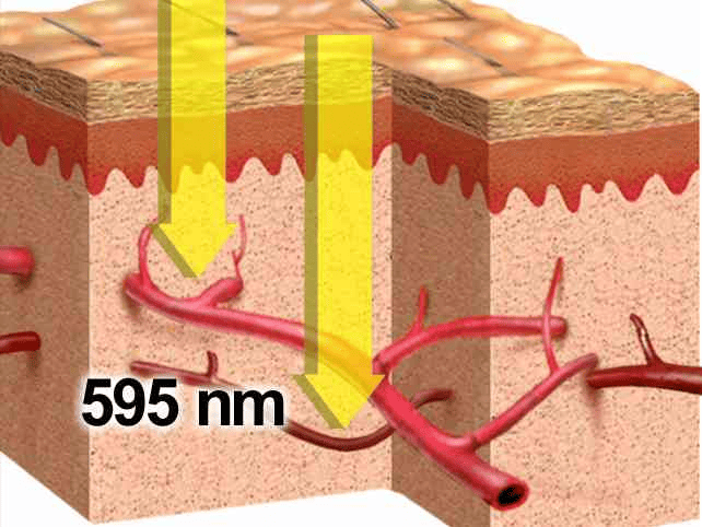 Vビーム2の照射イメージ
