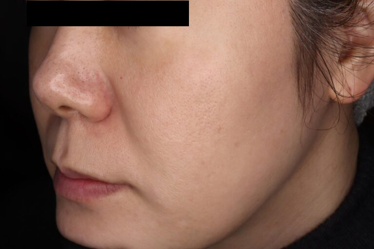 ピココンビ 3回後