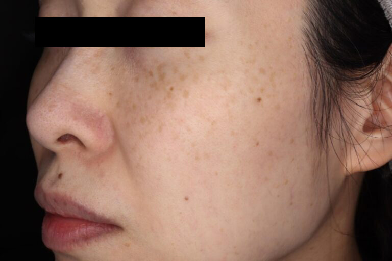 ピコスポット取り放題 施術前