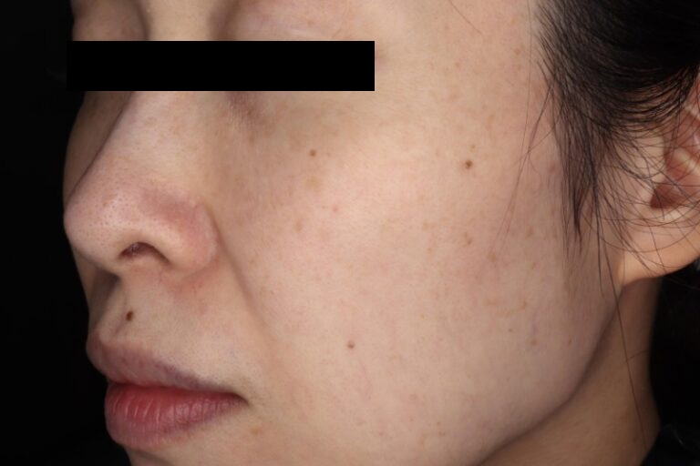 ピコスポット取り放題 施術後1ヶ月