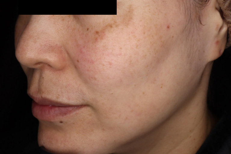 ピコトーニング施術前