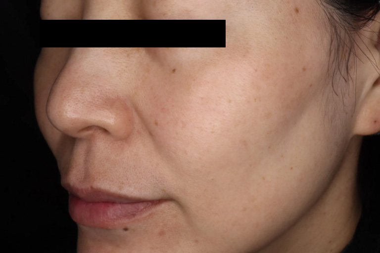 ピコトーニング6回後