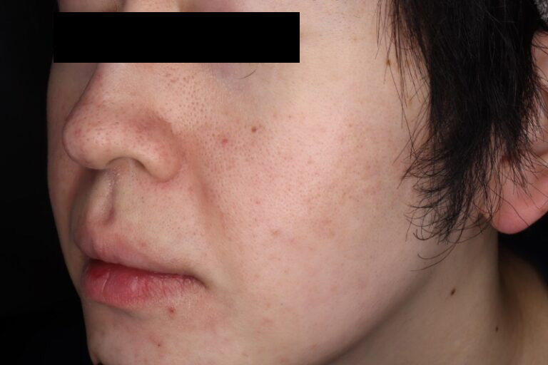 ピコフラクショナル前