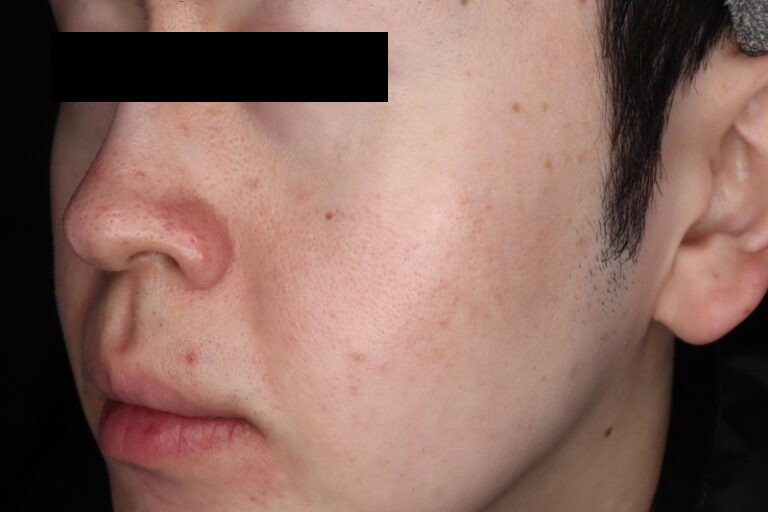 ピコフラクショナル 6回後